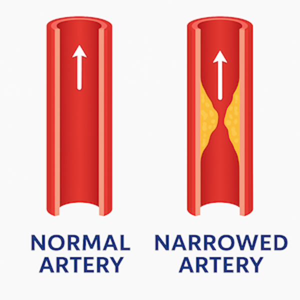 https://unitedveincenters.com/wp-content/uploads/2025/10/normal_artery_vs_narrowed_artery-1.png