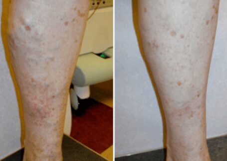 https://unitedveincenters.com/wp-content/uploads/2025/10/spider_veins_leg_before_and_after_4.jpg