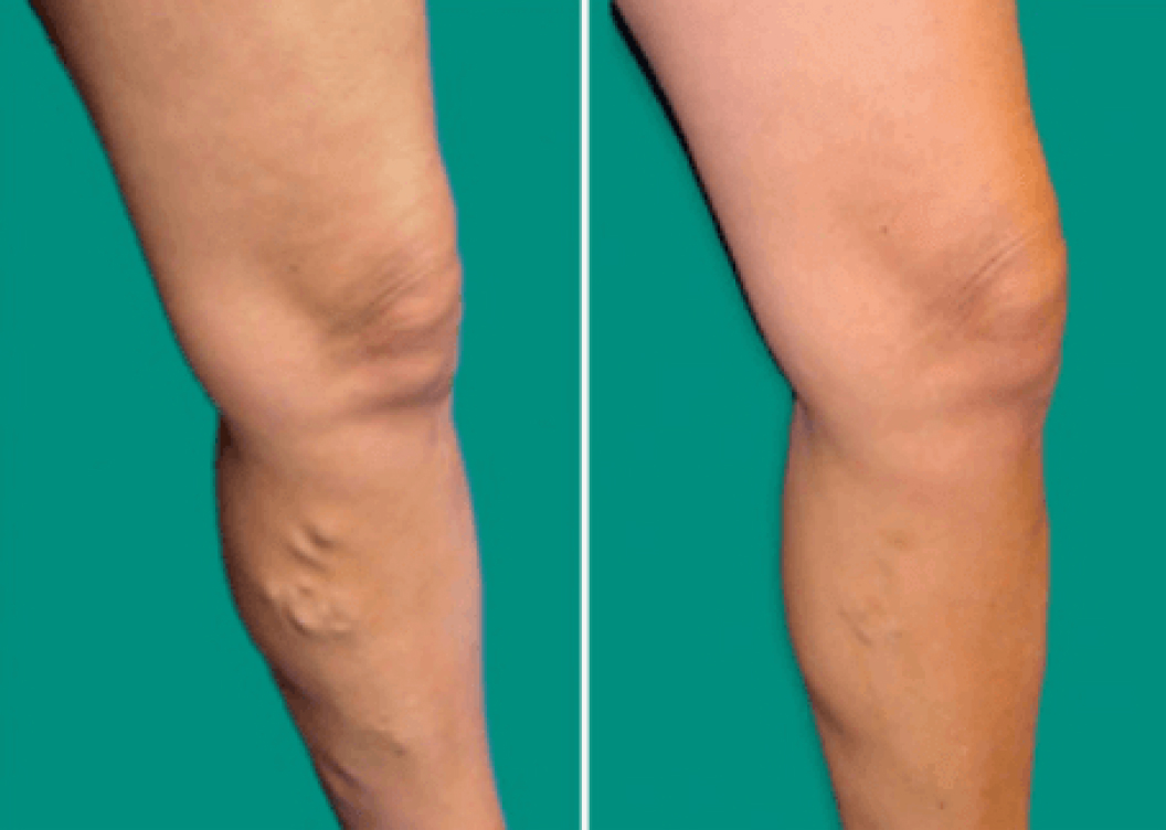 https://unitedveincenters.com/wp-content/uploads/2025/10/varicose_vein_leg_before_and_after-1024x729.jpg