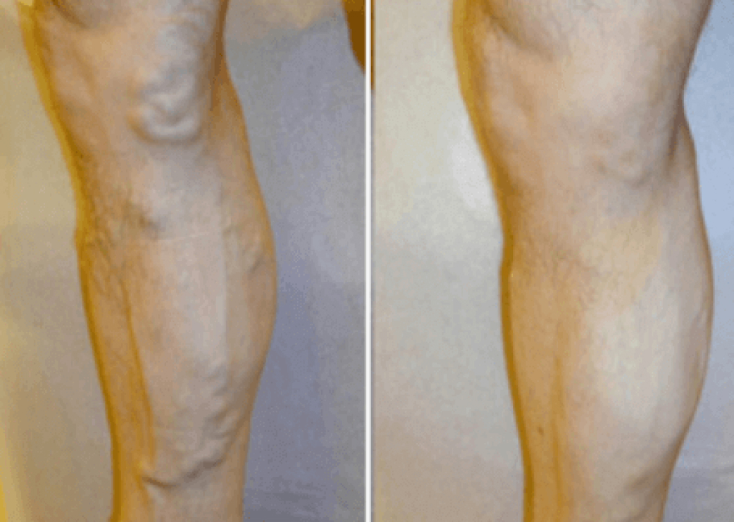 https://unitedveincenters.com/wp-content/uploads/2025/10/varicose_veins_leg_before_and_after_2-1024x729.jpg