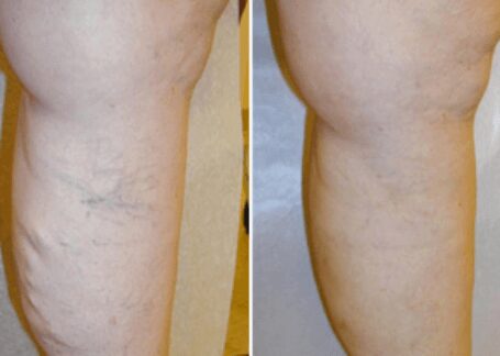 https://unitedveincenters.com/wp-content/uploads/2025/10/varicose_veins_leg_before_and_after_3.jpg