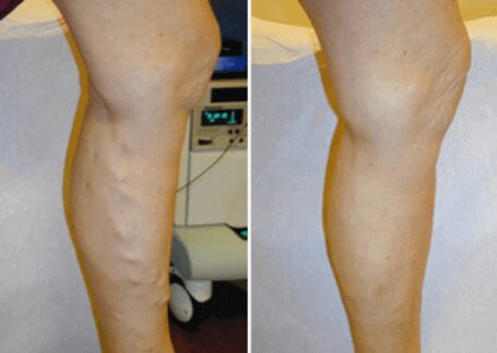 https://unitedveincenters.com/wp-content/uploads/2025/10/varicose_veins_leg_before_and_after_5.jpg