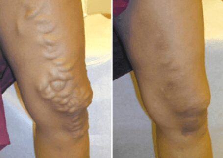 https://unitedveincenters.com/wp-content/uploads/2025/10/varicose_veins_leg_before_and_after_6.jpg