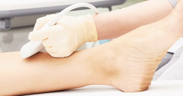 Microphlebectomy vs. Sclerotherapy: Which Is Right for Small Veins?