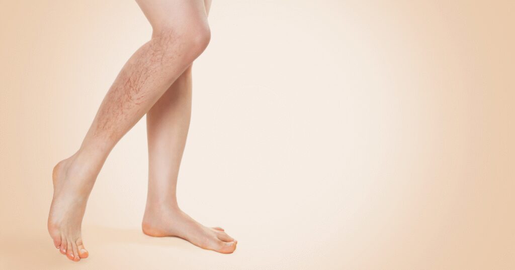 Are Red Veins a Sign of Any Serious Health Issues?