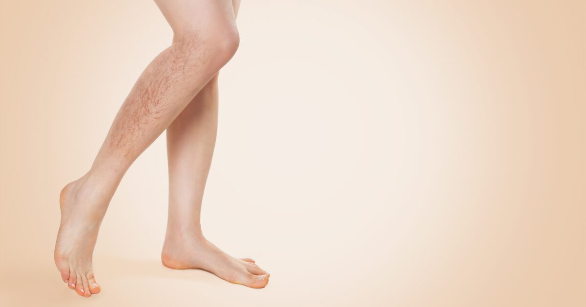 Are Red Veins a Sign of Any Serious Health Issues?