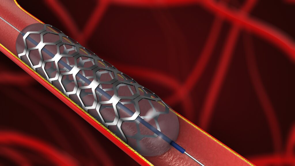 An illustration showing how an angioplasty removes plaque buildup from an artery