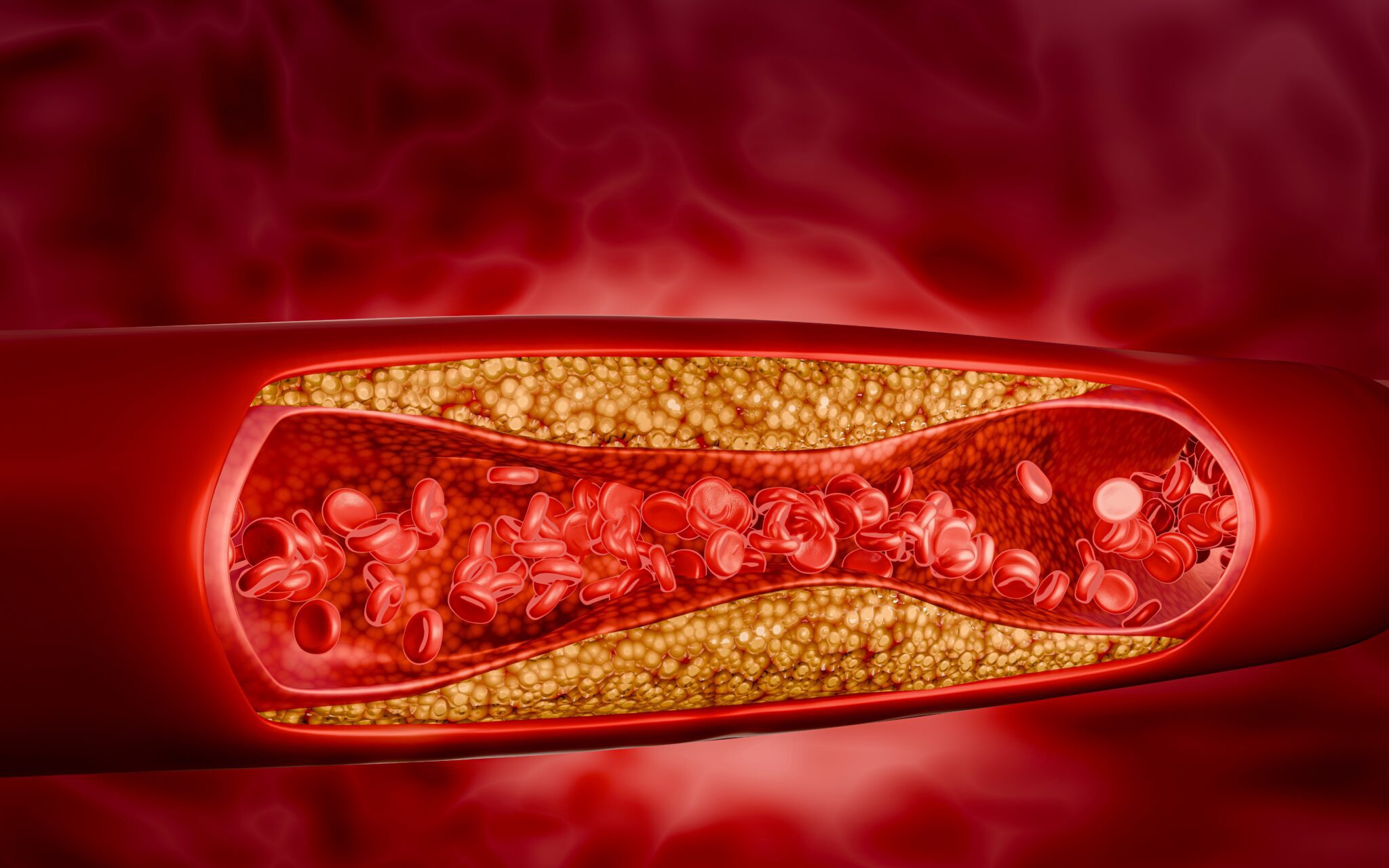 https://unitedveincenters.com/wp-content/uploads/2025/11/atherosclerosis_illustration-1024x640.jpg