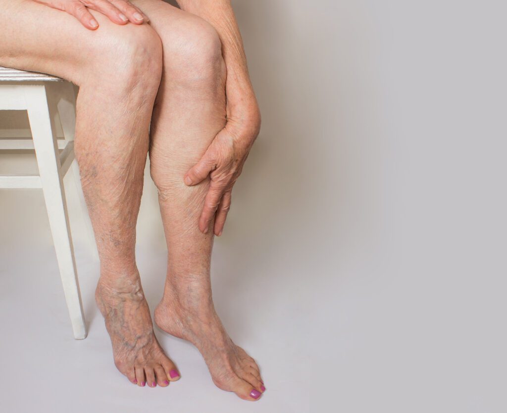 An elderly woman's legs with varicose veins in need of compression therapy