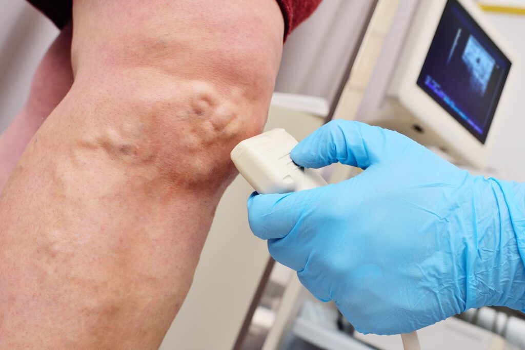Gloved medical professional performing a diagnostic ultrasound on a patient’s leg with visible varicose veins to assess vein health and circulation