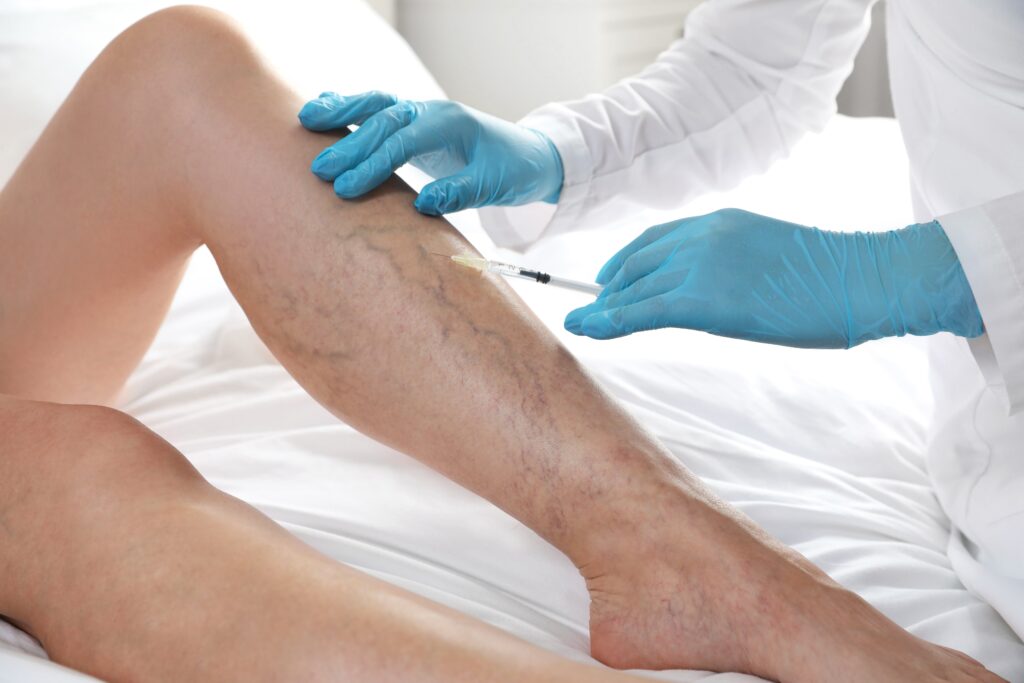 Healthcare professional wearing blue gloves administering a sclerotherapy injection into visible varicose veins on a patient’s lower leg.