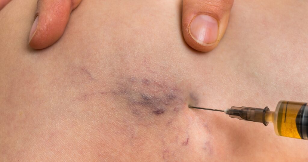 Vein Conditions You Might Miss: Early Signs in Unusual Areas