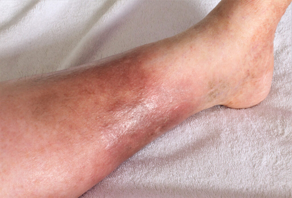 A man's lower leg shown with skin discoloration and bruising