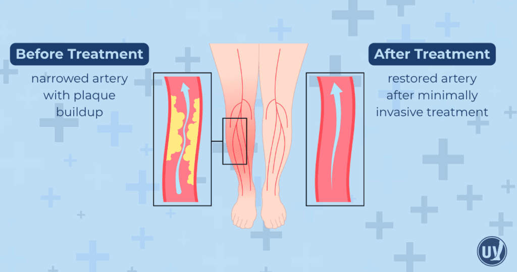 Before and after PAD treatment