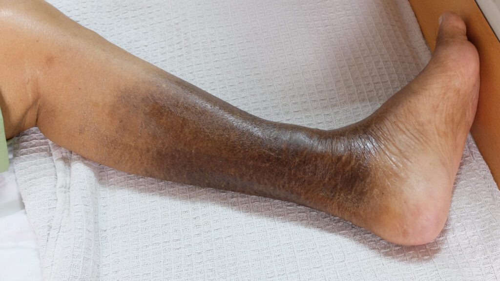 A male's lower leg with warning signs of venous insufficiency
