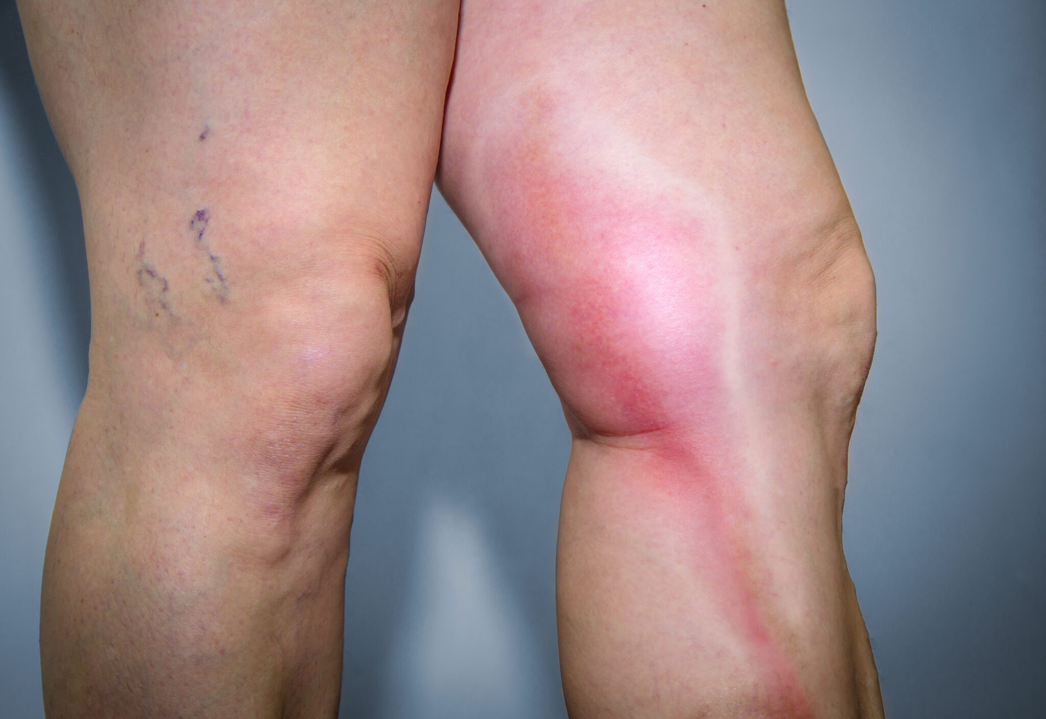 https://unitedveincenters.com/wp-content/uploads/2025/12/symptoms_of_phlebitis-1024x704.jpg