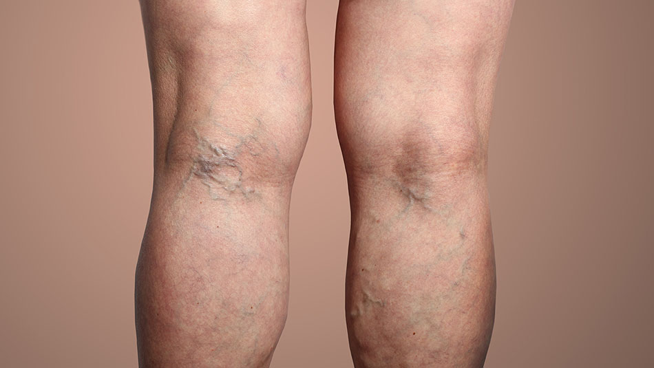 Backside of a person's legs showing lots of blue bulging veins