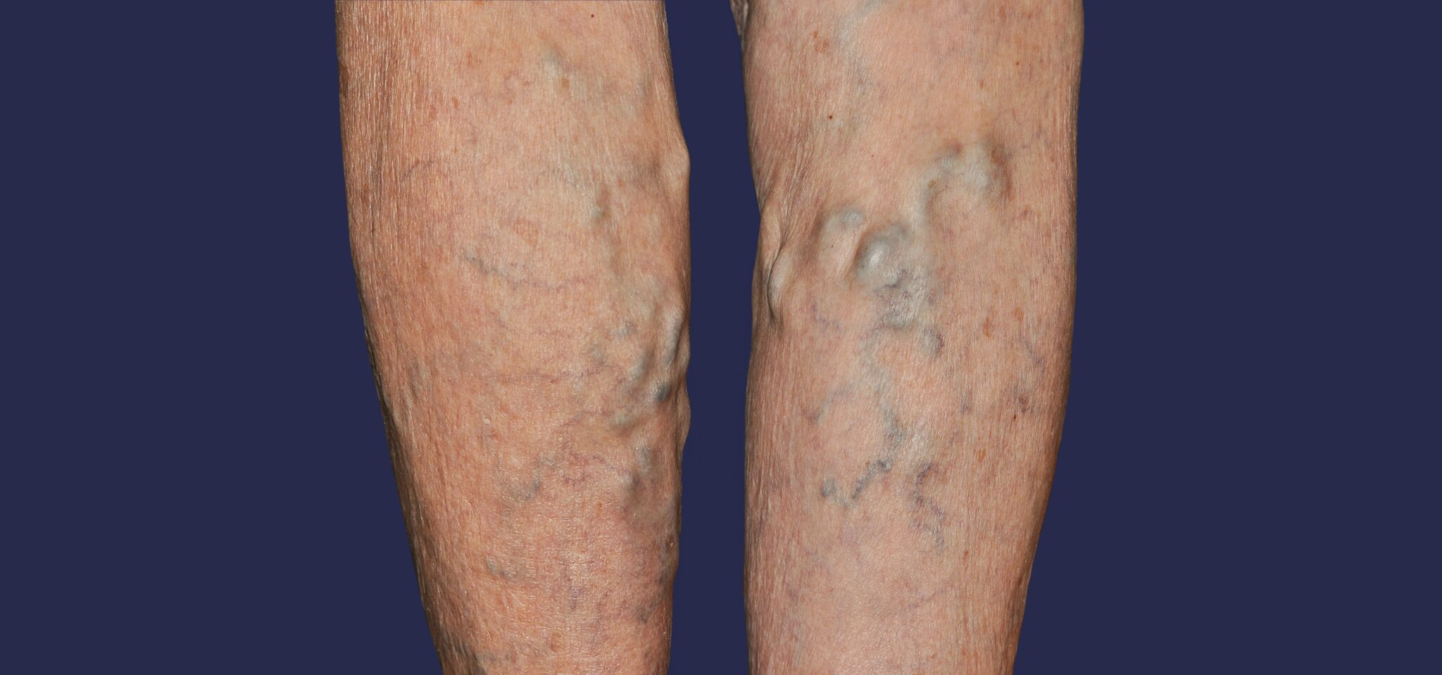 https://unitedveincenters.com/wp-content/uploads/2025/12/what_Causes_phlebitis-1024x480.jpg