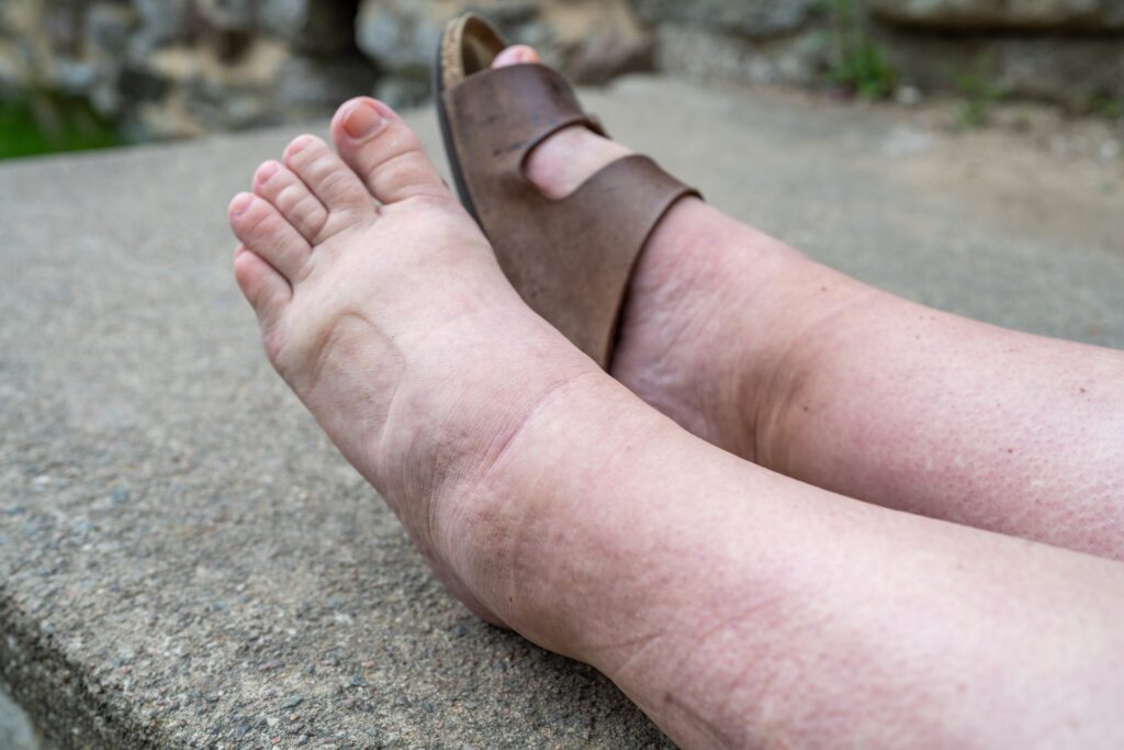 A person's lower leg showing excessing swelling and indentations from their shoes across their feet