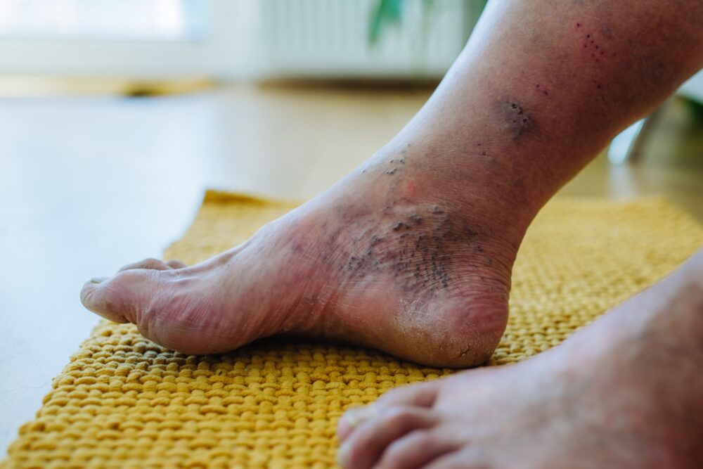 A foot showing blue and purple veins with ulcers starting to form