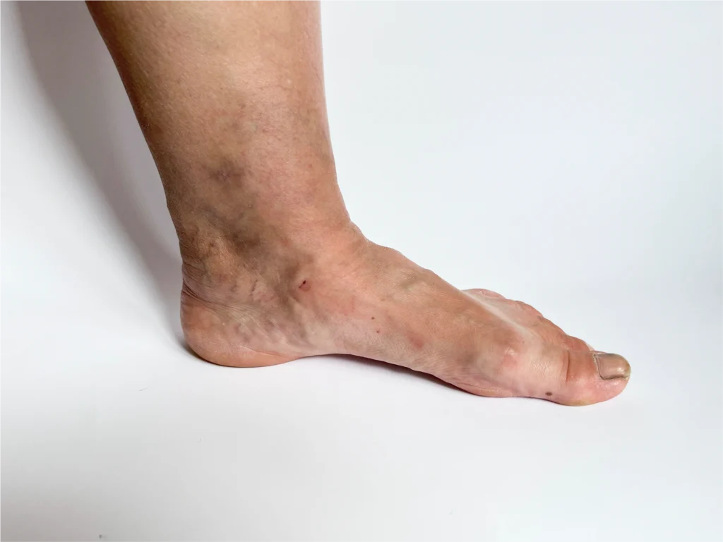 A foot and lower leg with skin discoloration due to vein disease