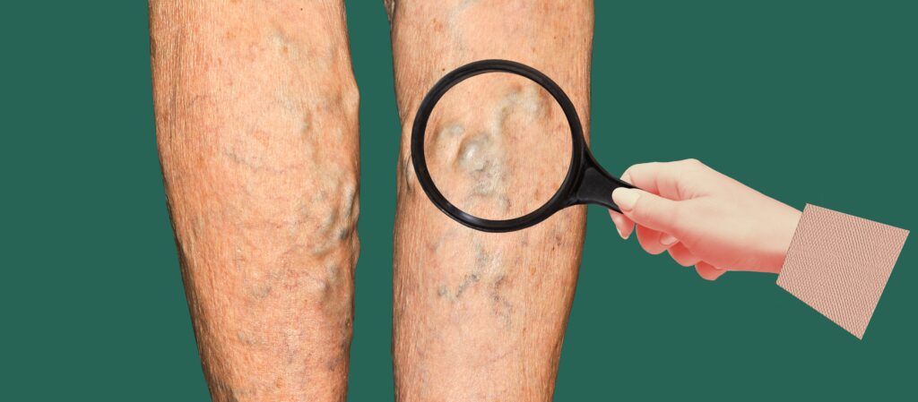 investigating veiny legs for signs of DVT with a magnifier