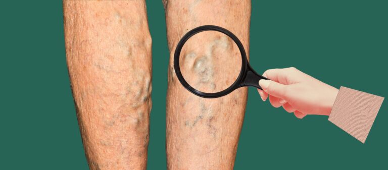 investigating veiny legs for signs of DVT with a magnifier