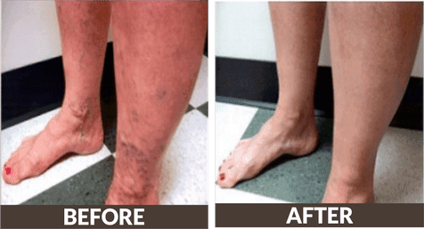 Vein ablation before and after