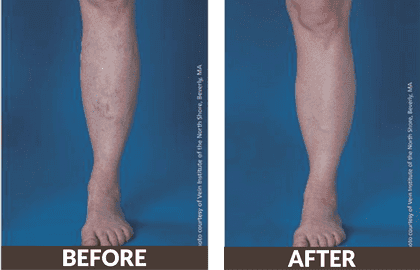 Lower legs spider vein treatment before and after