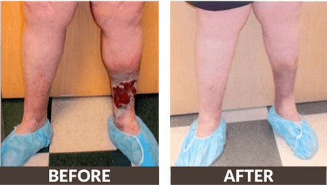 Female leg ulcer picture before and after