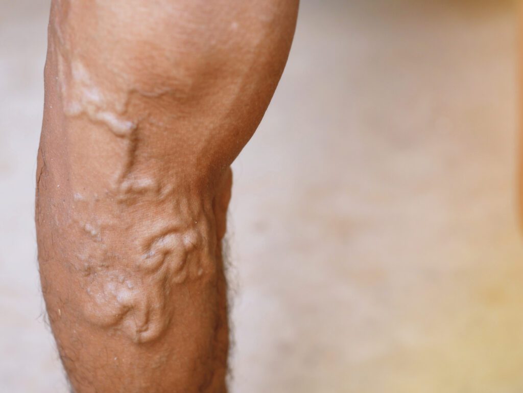 A muscular upper arm with bulging varicose veins