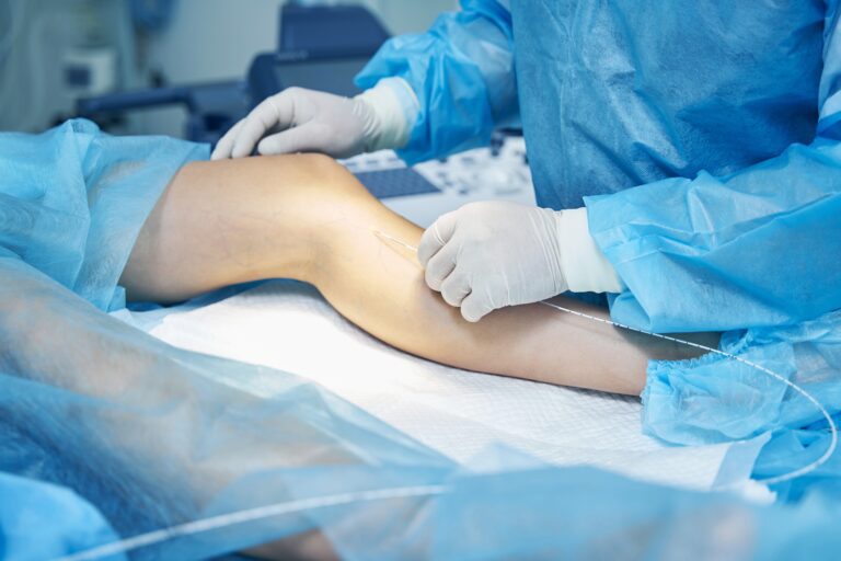 A tiny catheter is inserted into the leg to seal the vein closed.