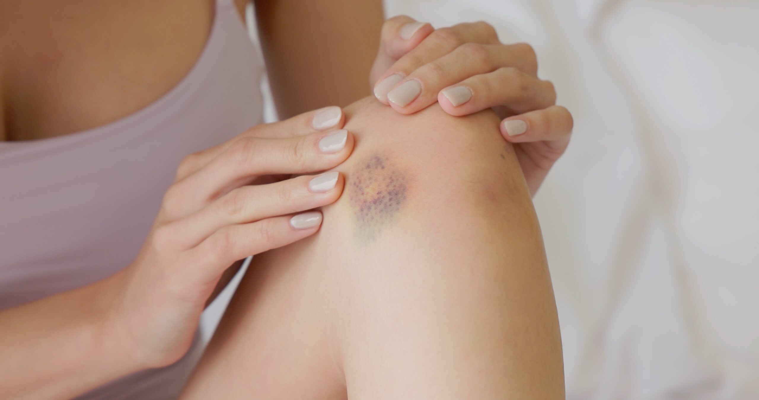 Unusual bruise on a woman's leg