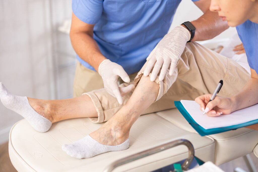 A person's lower leg varicose veins are being examined by a vein specialist