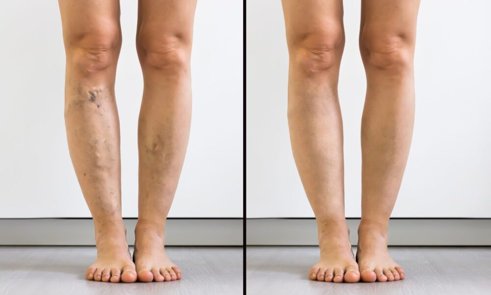 Legs shown before and after varicose vein treatment