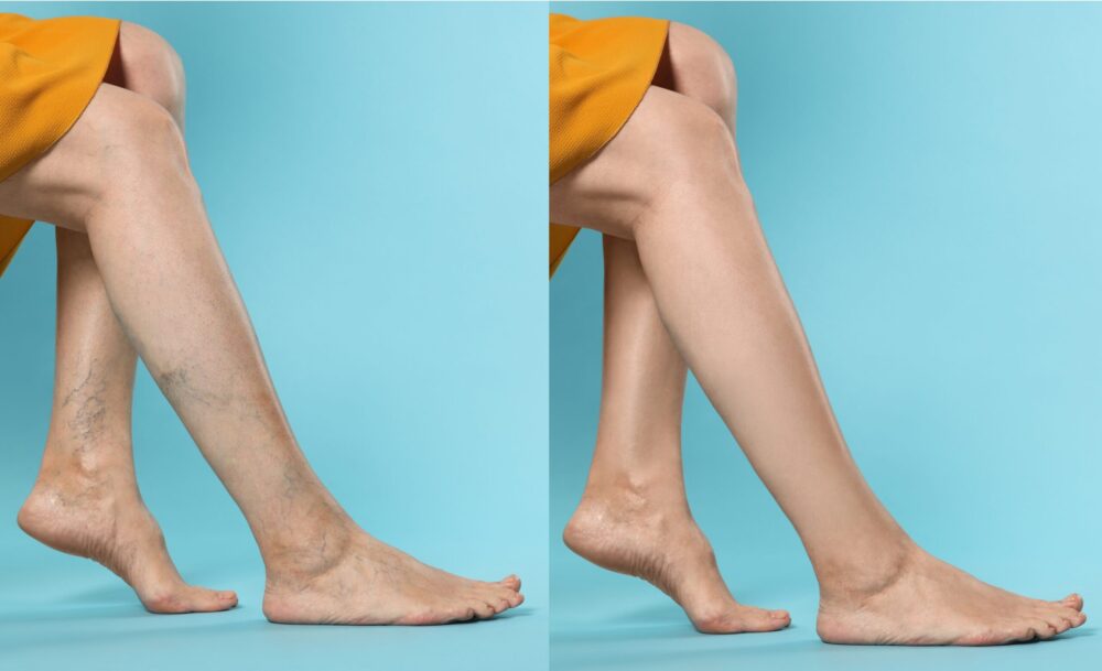 Legs shown before and after varicose vein treatment
