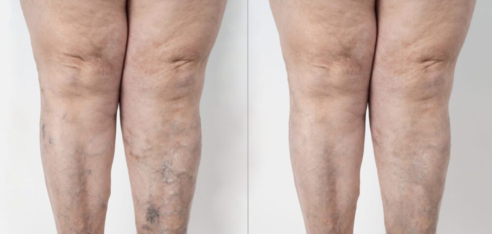 Legs shown before and after varicose vein treatment
