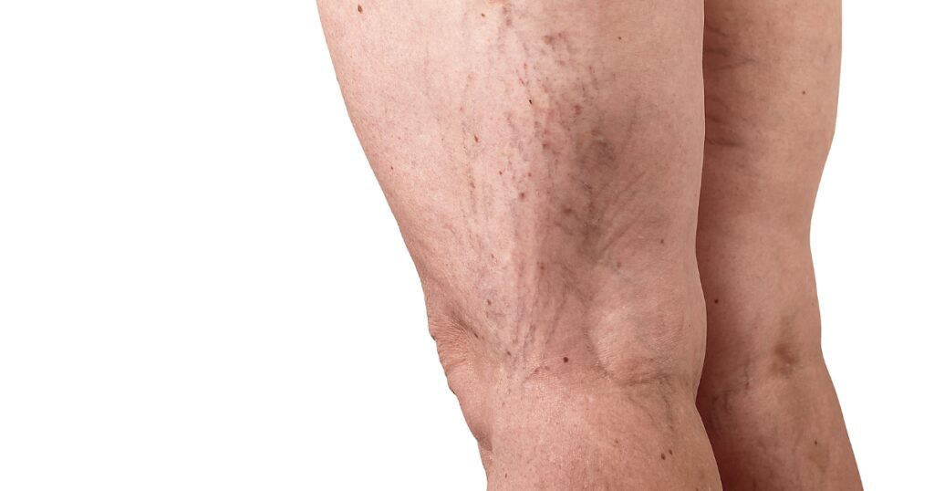 blood pooling in the legs