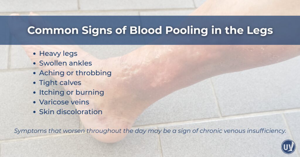 graphic discussing common signs of blood pooling in the legs