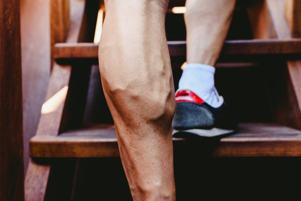 Calf muscles with varicose veins that could benefit from a phlebectomy