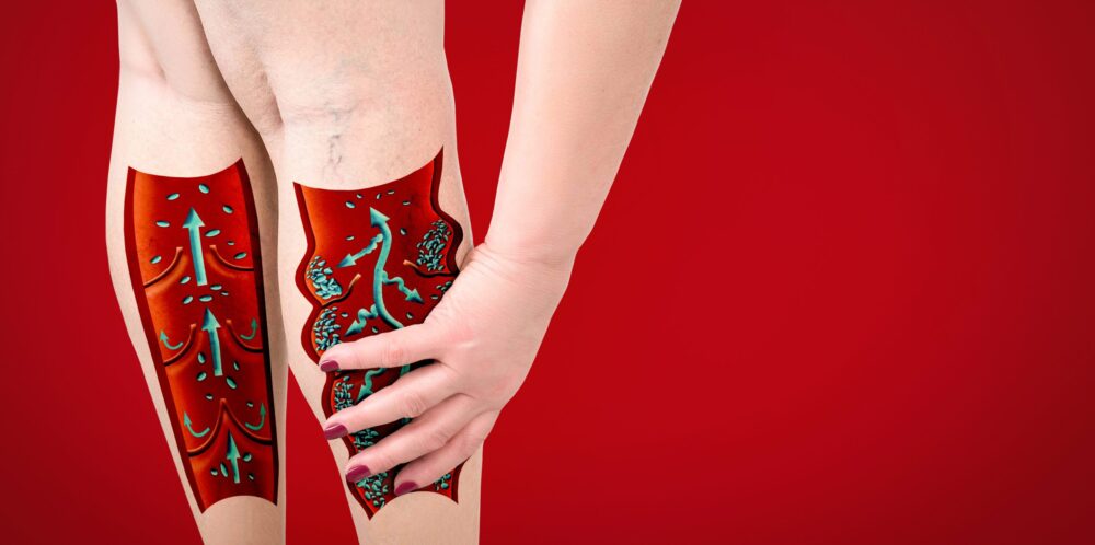 Woman holding her lower leg due to heaviness and poor circulation