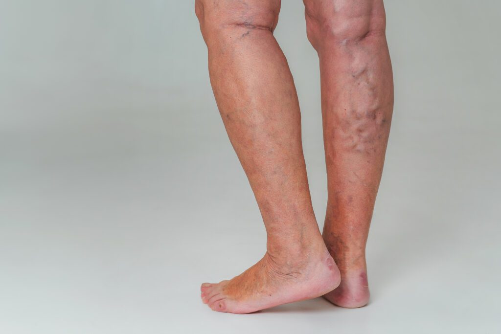 Phlebectomy for varicose vein removal