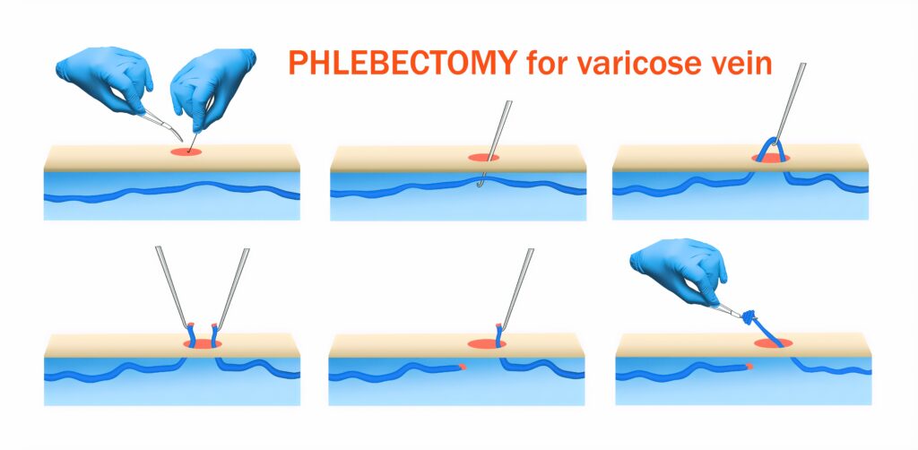 Illustration of a phlebectomy vein removal
