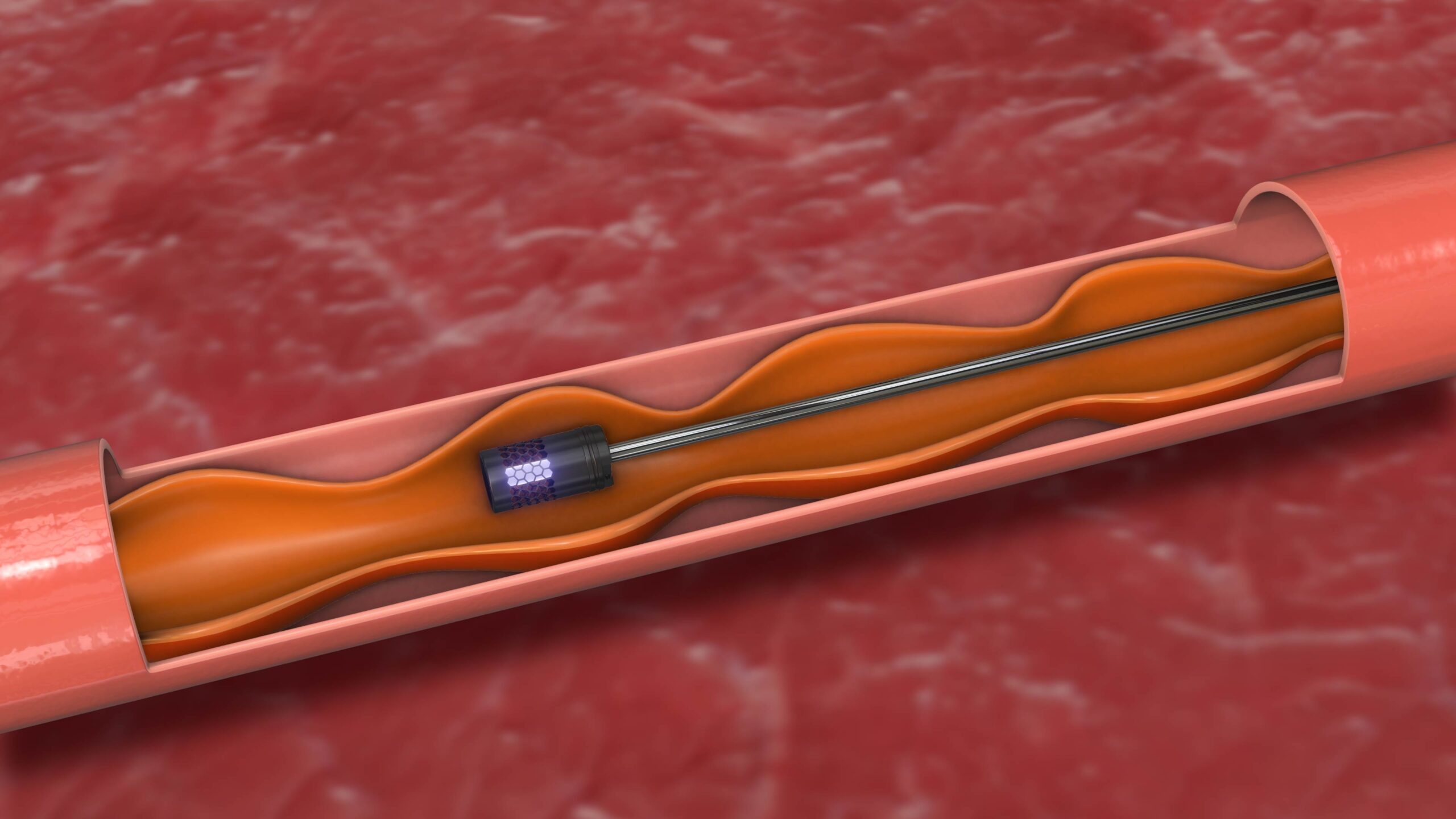 RFA for varicose veins