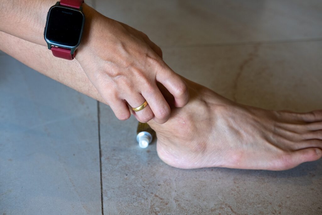 Female scratching ankle due to vein disease