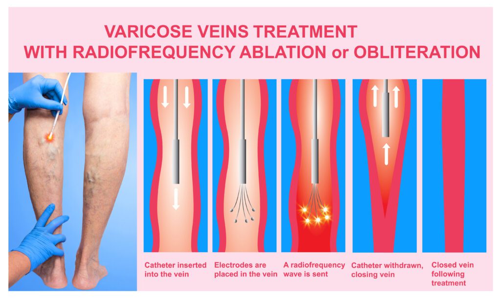 RFA procedure to close veins