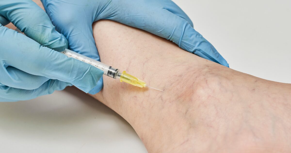 A vascular specialist perfomring a Minimally Invasive Varicose Vein Treatment in Brenham