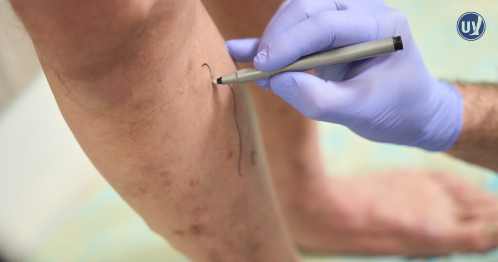 Denver vein specialist vein mapping on patient