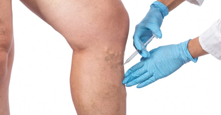 Vein specialist treating patient leg veins