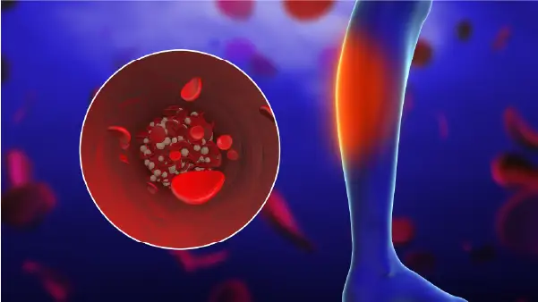 Illustration of a blood clot in the leg